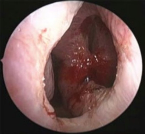 Perforation de la cloison nasale