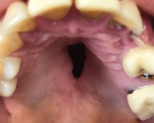 Perforation du palais